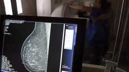 Tela exibe imagem de mamografia durante atendimento de saúde, em registro de arquivo de outubro de 2024.