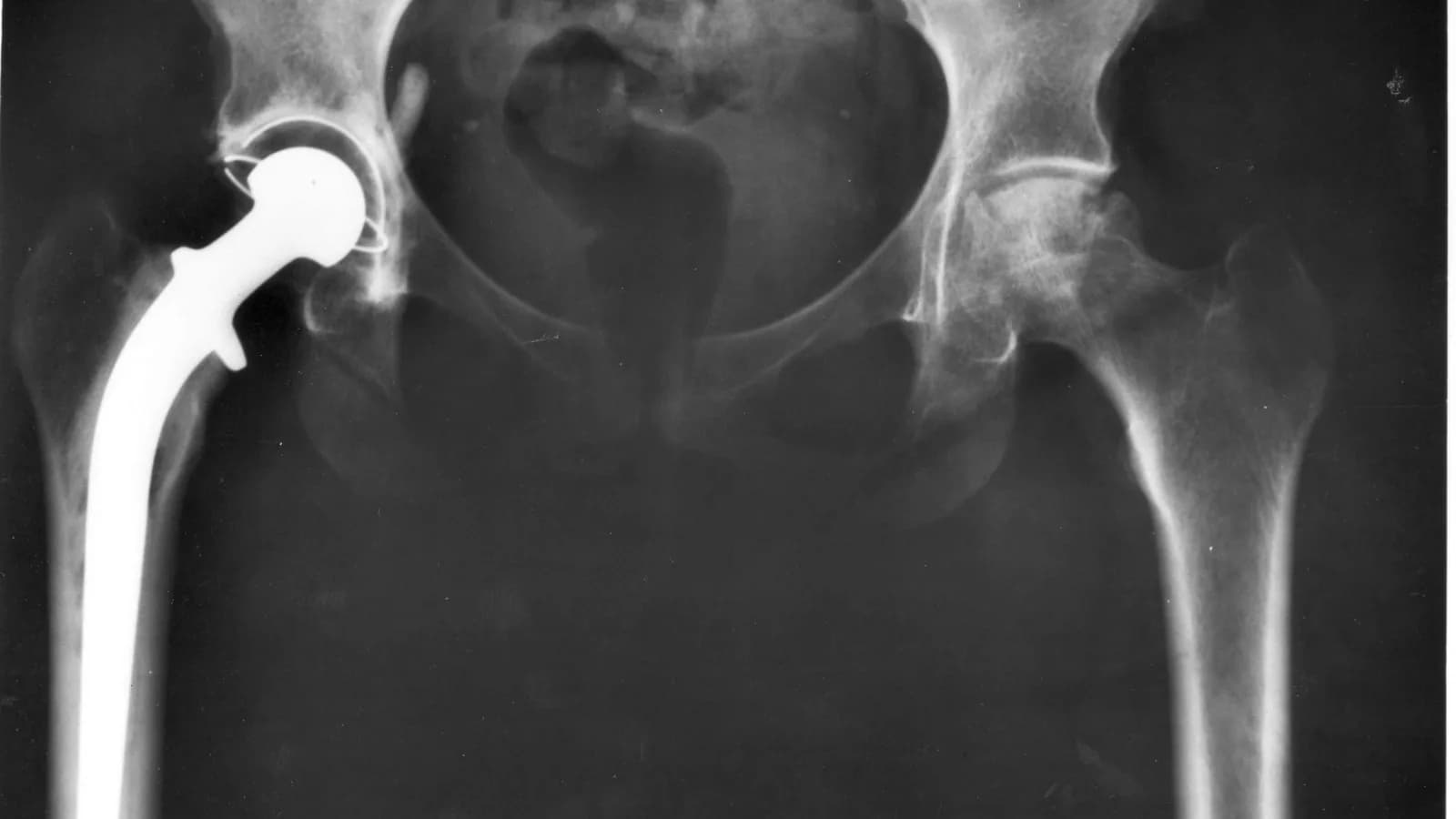 Raio-X de prótese ortopédica implantada no quadril