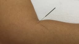 Sessão de acupuntura com agulha aplicada no braço