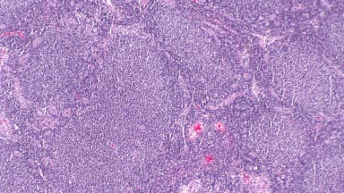 Imagem de microscopia mostra tecido com linfoma folicular, tipo de câncer tratado pelo novo medicamento aprovado pela Anvisa