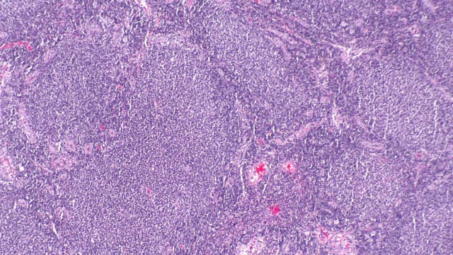 Imagem de microscopia mostra tecido com linfoma folicular, tipo de câncer tratado pelo novo medicamento aprovado pela Anvisa
