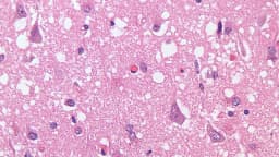 Imagem microscópica de tecido cerebral mostra degeneração espongiforme característica da doença de Creutzfeldt-Jakob