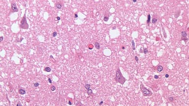 Imagem microscópica de tecido cerebral mostra degeneração espongiforme característica da doença de Creutzfeldt-Jakob