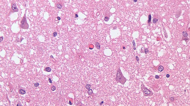 Imagem microscópica de tecido cerebral mostra degeneração espongiforme característica da doença de Creutzfeldt-Jakob