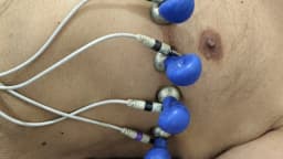 Peito de paciente com eletrodos de eletrocardiograma conectados para exame cardíaco
