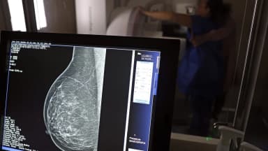 Mamografia sendo realizada em mulher, com imagem do exame exibida em monitor