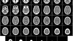 Sequência de imagens de tomografia computadorizada do cérebro humano em cortes axiais