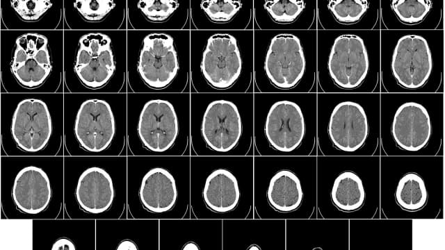 Sequência de imagens de tomografia computadorizada do cérebro humano em cortes axiais
