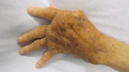 Mão com deformidade articular causada por artrite reumatoide avançada