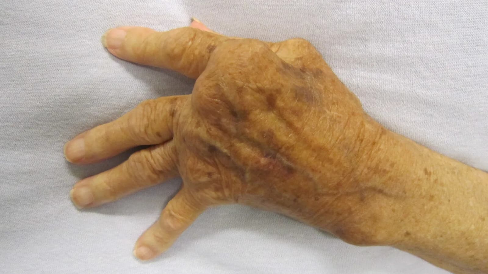 Mão com deformidade articular causada por artrite reumatoide avançada