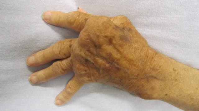 Mão com deformidade articular causada por artrite reumatoide avançada
