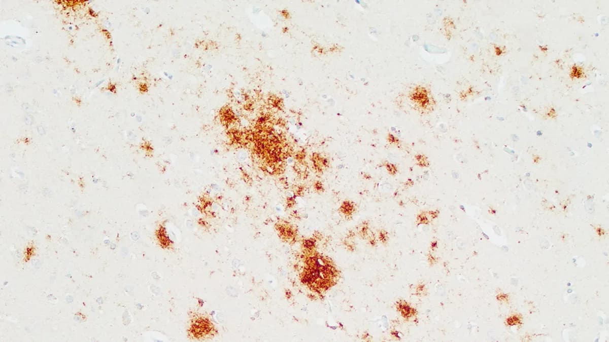 Imagem microscópica mostra depósitos de proteína príon em tecido cerebral, característicos da doença de Creutzfeldt-Jakob