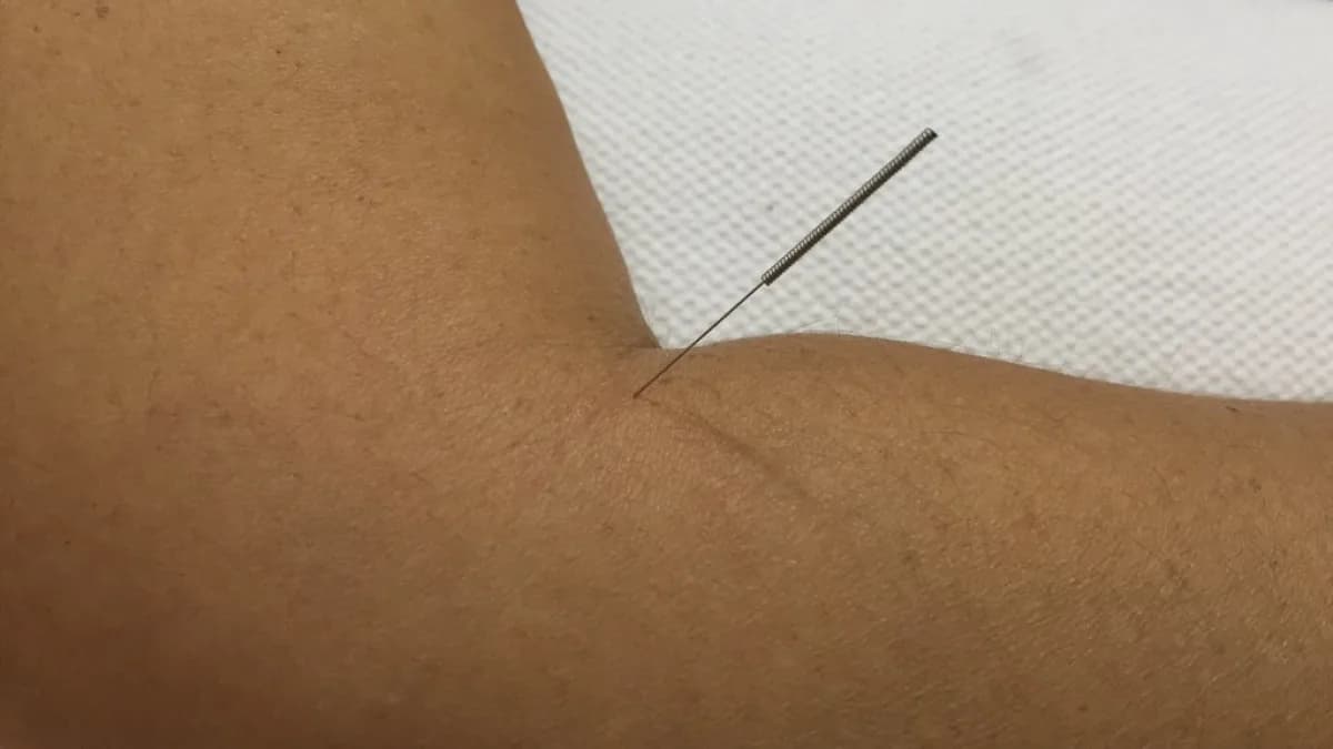 Sessão de acupuntura com agulha aplicada no braço