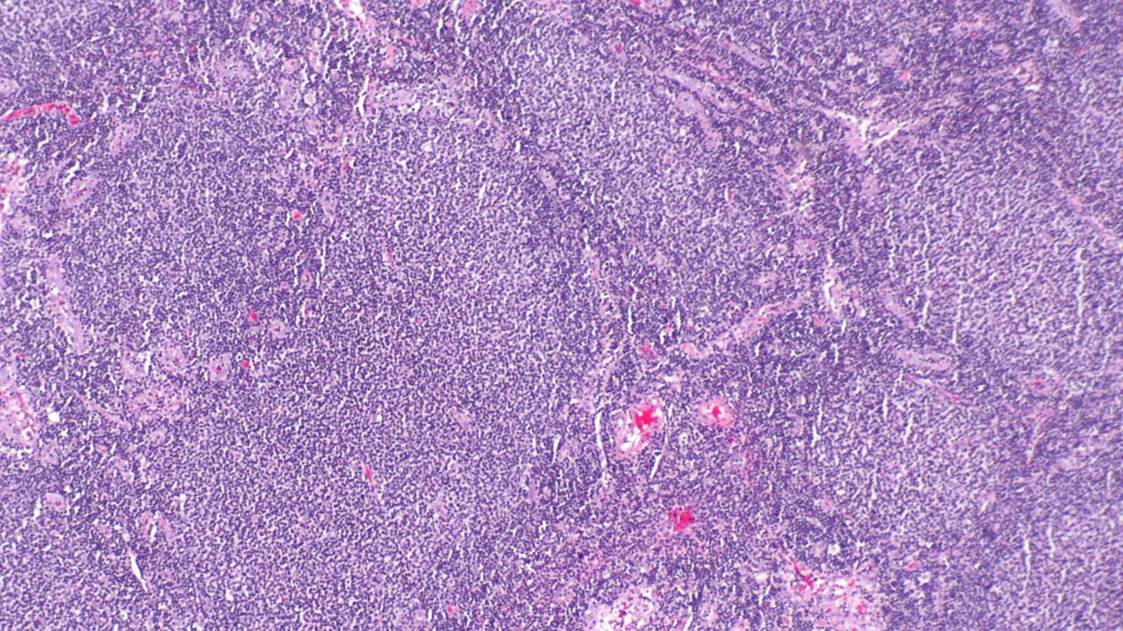Imagem de microscopia mostra tecido com linfoma folicular, tipo de câncer tratado pelo novo medicamento aprovado pela Anvisa
