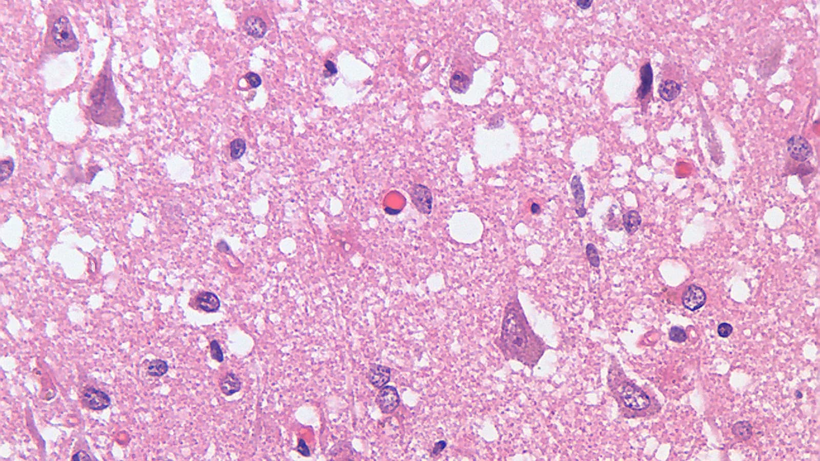 Imagem microscópica de tecido cerebral mostra degeneração espongiforme característica da doença de Creutzfeldt-Jakob