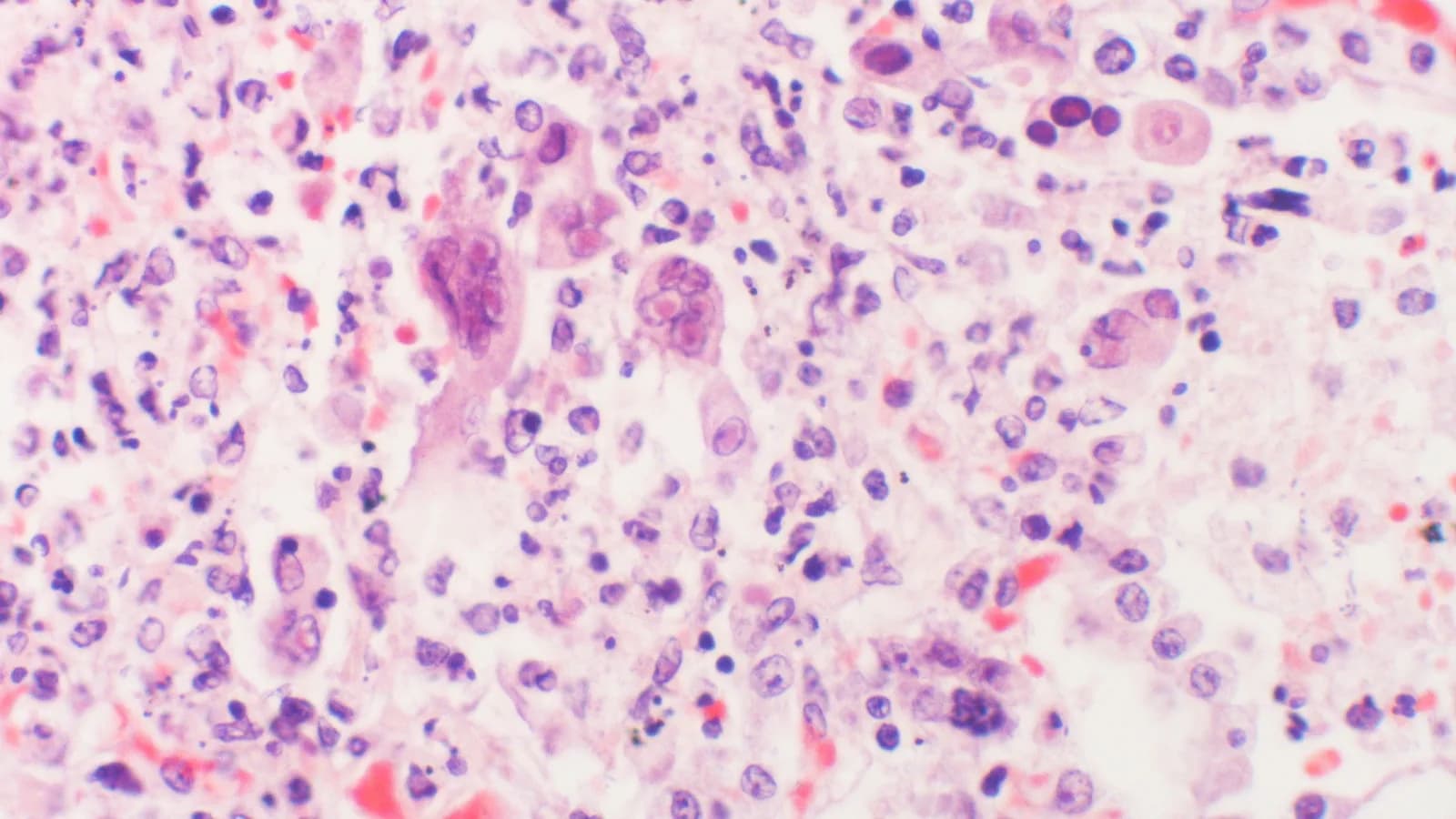 Imagem de microscopia mostrando tecido infectado pelo vírus herpes simplex