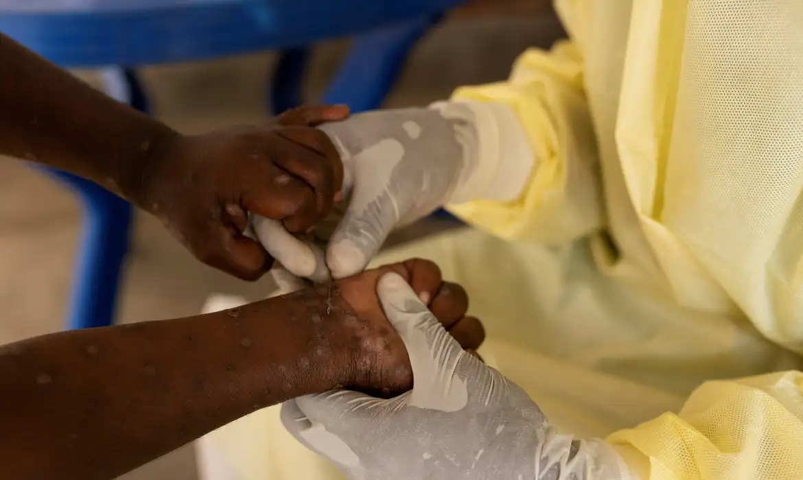 Investigação de caso de mpox em Sete Lagoas